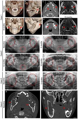 Case Report: Safety and Efficacy of Denosumab in Four Children With Noonan Syndrome With Multiple Giant Cell Lesions of the Jaw